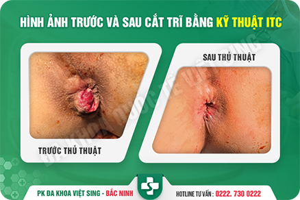 Hình ảnh trước sau cắt trĩ bằng ITC