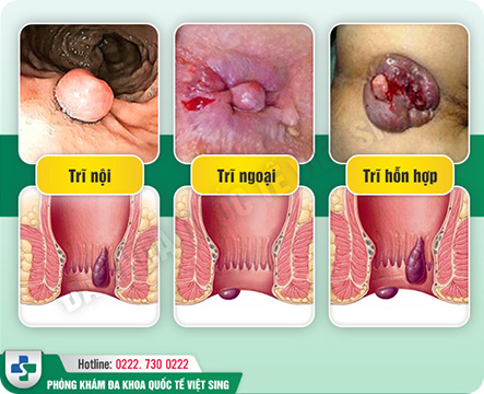 DO CHẾ ĐỘ ĂN UỐNG, SINH HOẠT
