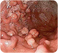 POLYP TRỰC TRÀNG