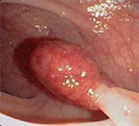 POLYP TRỰC TRÀNG