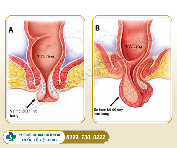 Tôi bị sa trực tràng lâu ngày thì có làm sao không?