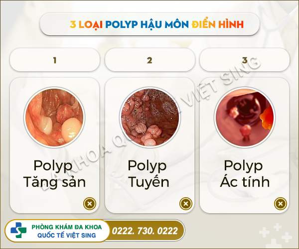 Polyp hậu môn là gì? Phương pháp điều trị với bác sĩ chuyên khoa giỏi