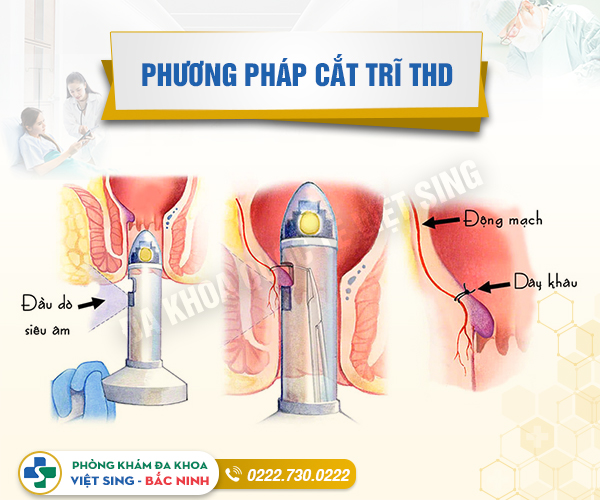 Thực hư phương pháp cắt trĩ THD có hiệu quả không?