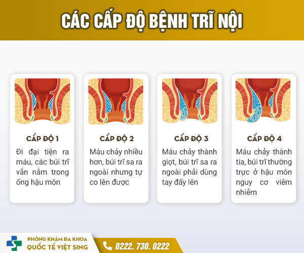 ĐỪNG CHỦ QUAN: Áp dụng cách chữa và điều trị trĩ nội đúng, ngăn ngừa biến chứng