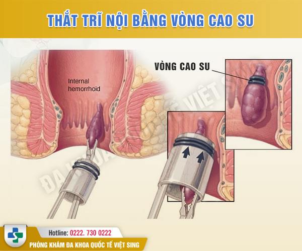 Hỏi đáp về thắt búi trĩ bằng vòng cao su: Từ A đến Z mọi điều bạn cần biết
