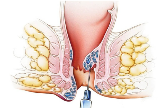 Tiêm búi trĩ – Bật mí 6 sự thật không phải ai cũng biết rõ
