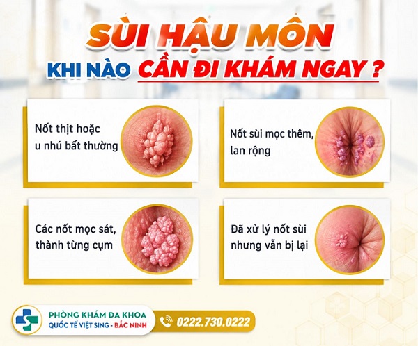 Nguyên nhân gây sùi hậu môn và cách chữa hạn chế tái phát